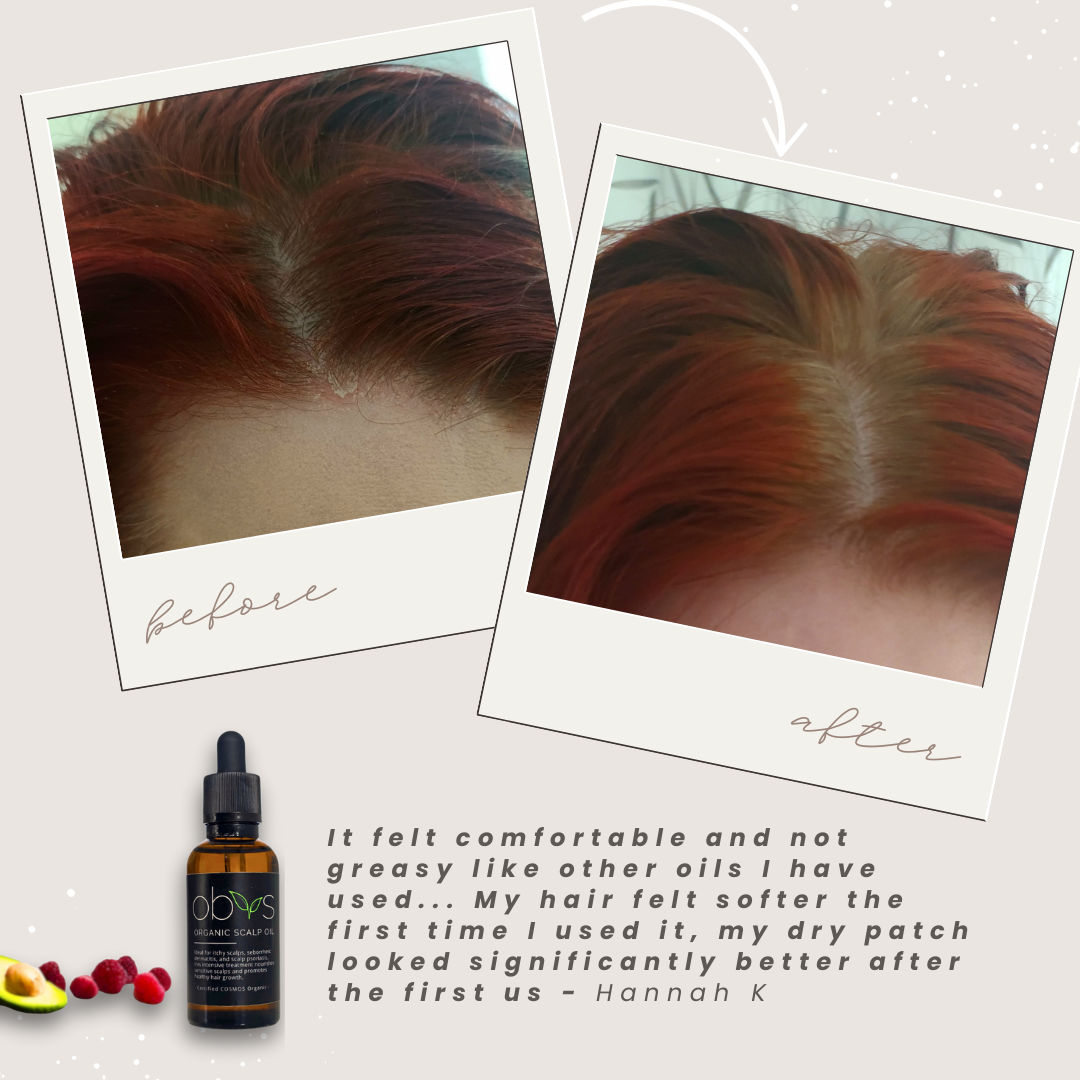 Organic Scalp Oil – Nourishing formula for hair growth, soothing sensitive scalps, and reducing dryness with natural, fragrance-free ingredients.