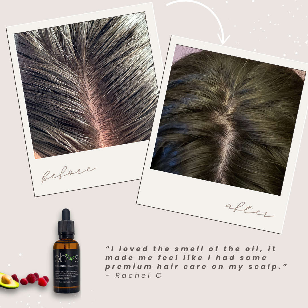 Organic Scalp Oil – Nourishing formula for hair growth, soothing sensitive scalps, and reducing dryness with natural, fragrance-free ingredients.