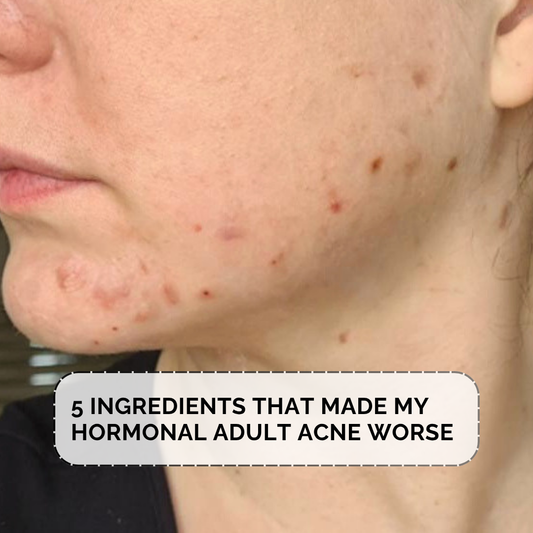 5 ingredients that may worsen adult acne including coconut oil, dairy and paraffin, plus why oil-based skincare helped oily skin.