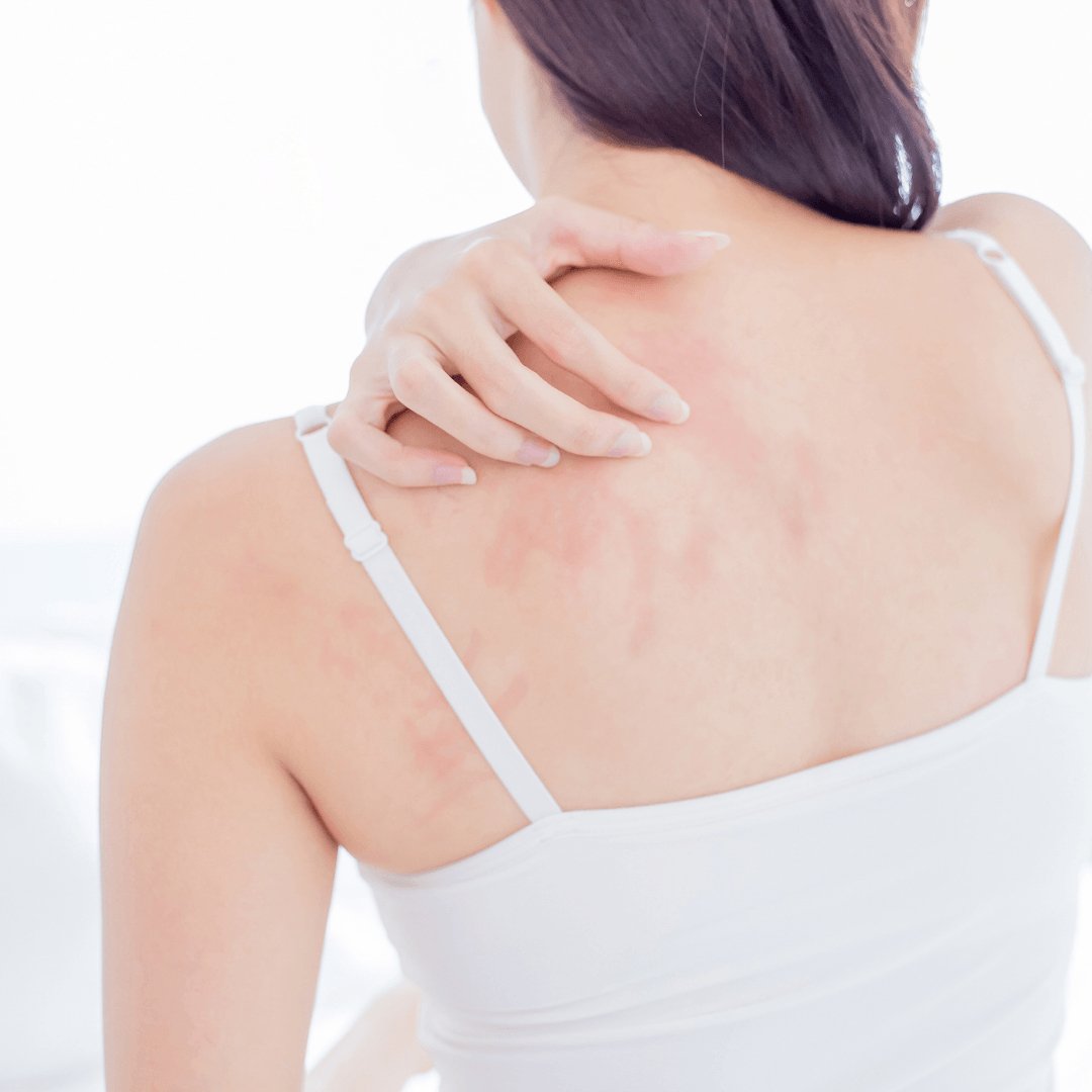 How to help prevent eczema from flaring up in the winter. - Obvs Skincare
