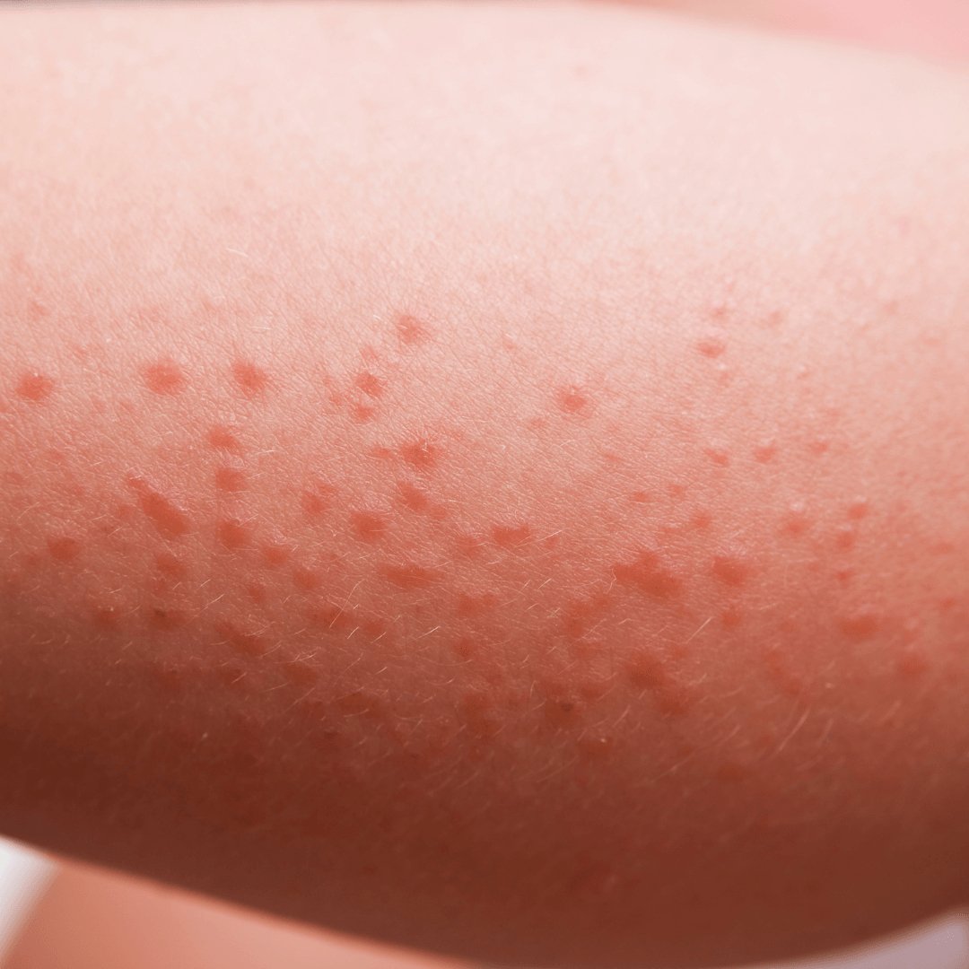 Realistic Heat Rash Is It Heat Rash Or Sun Rash and How To Prevent/Treat It.
