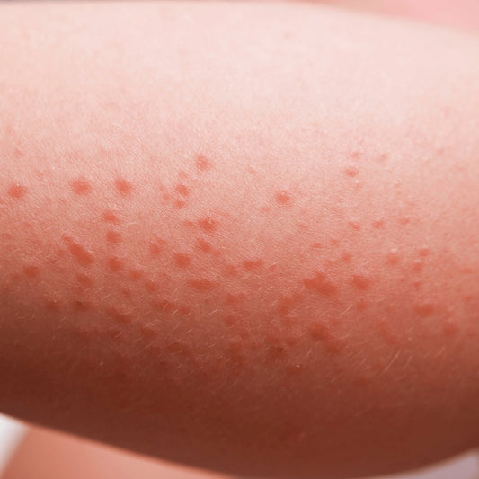 Is It Heat Rash Or Sun Rash and How To Prevent/Treat It. - Obvs Skincare