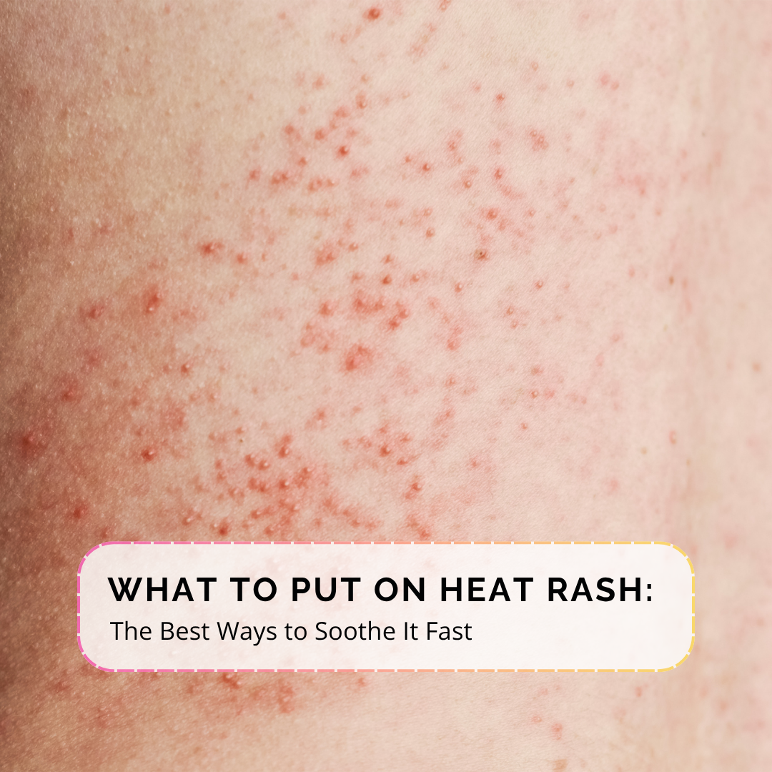 For SEO and accessibility, I’d keep it descriptive and natural:  **Alt text:** `Heat rash and sun rash causing red, irritated skin after sun exposure`