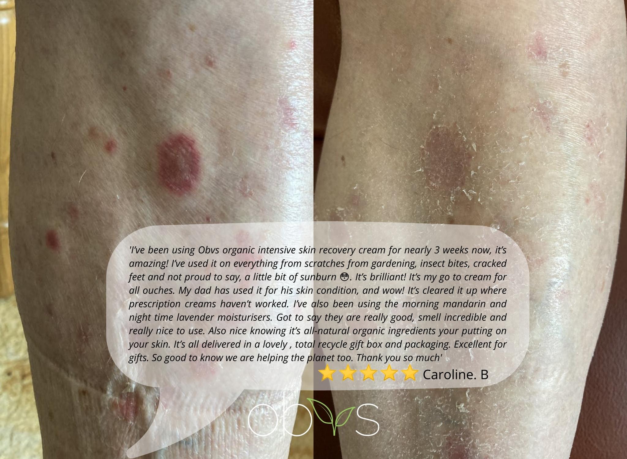 cream for eczema dry skin psoriasis dermatitis rosacea acne spots nappy rash minor burns Natural skincare skincareroutine beauty organicskincare healthyskin selfcare skincareproducts vegan cruelty free skincaretips beau23