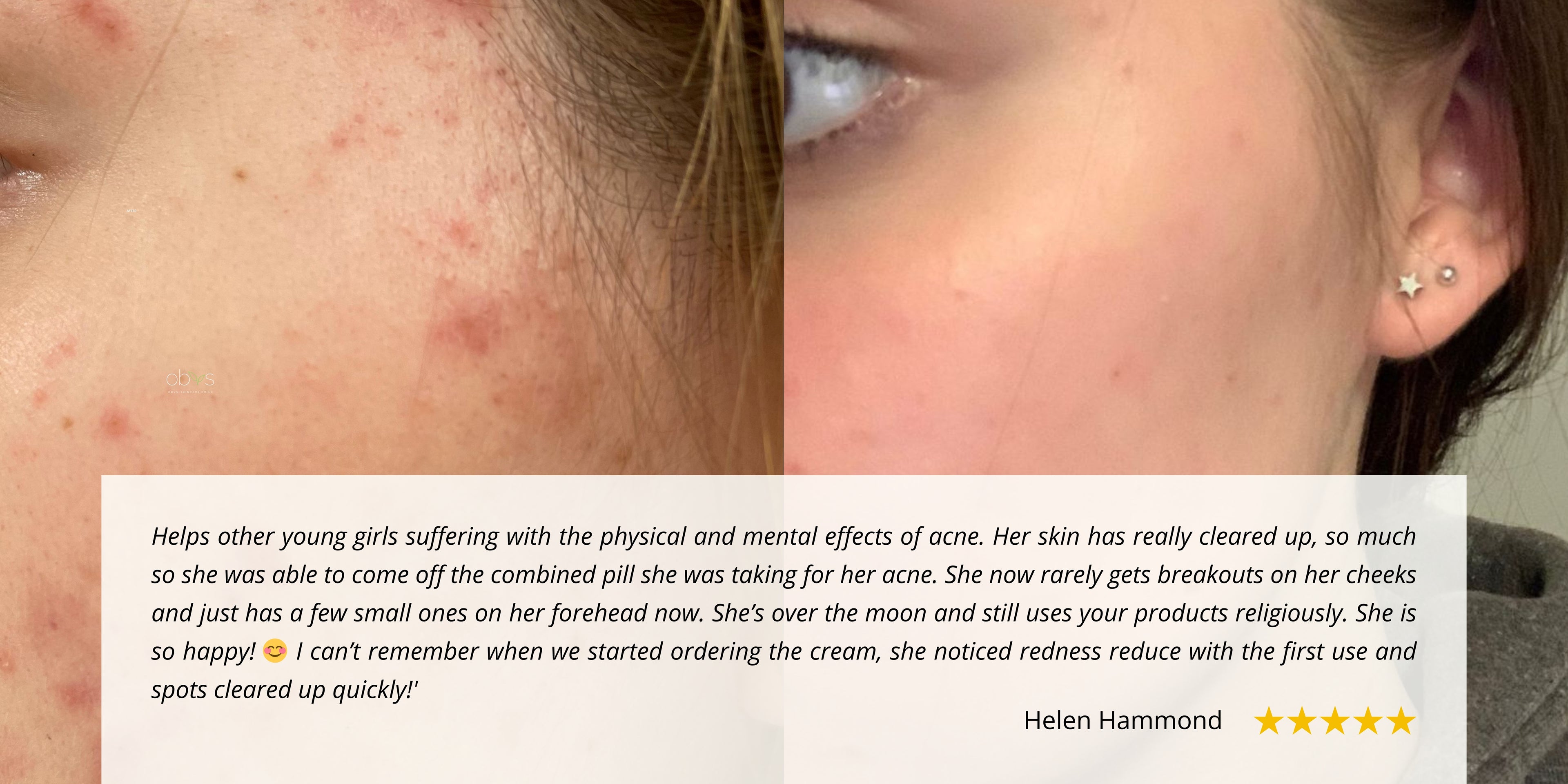 Side-by-side comparison of a teenager's cheek before and after using Obvs Skincare. The left shows red, inflamed acne breakouts; the right shows significantly clearer, calmer skin with reduced redness.
