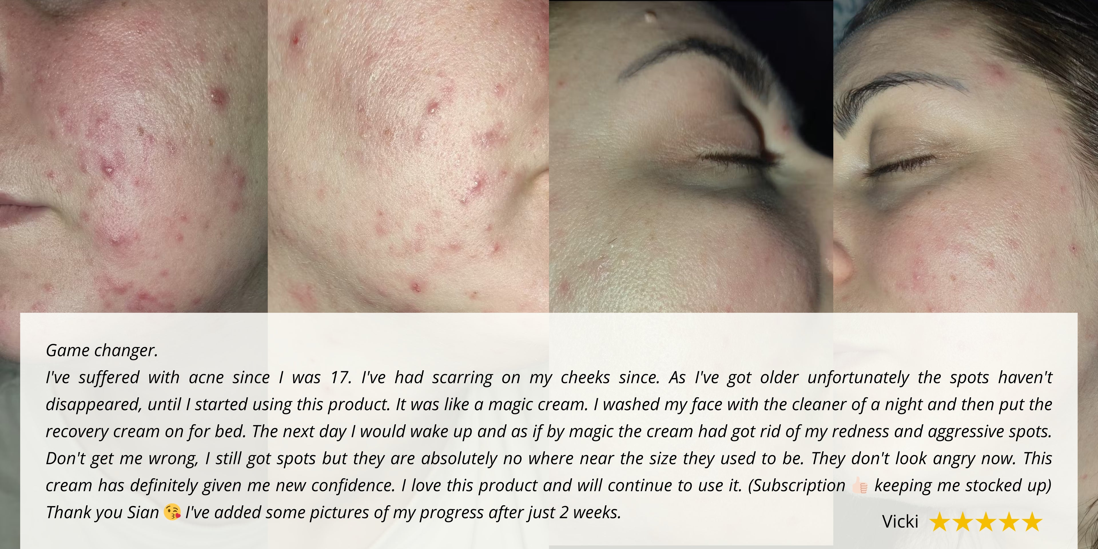 Side-by-side comparison of a teenager's cheek before and after using Obvs Skincare. The left shows red, inflamed acne breakouts; the right shows significantly clearer, calmer skin with reduced redness.