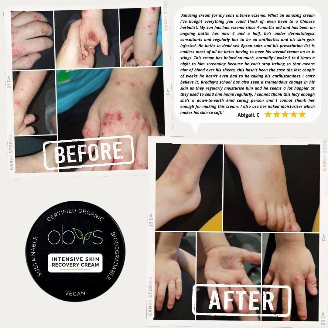 Turning Pain into Purpose – The Real Story Behind Obvs Skincare